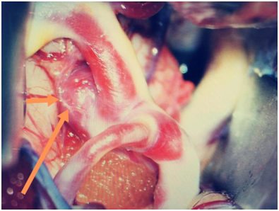 “不定時炸彈”腦動脈瘤